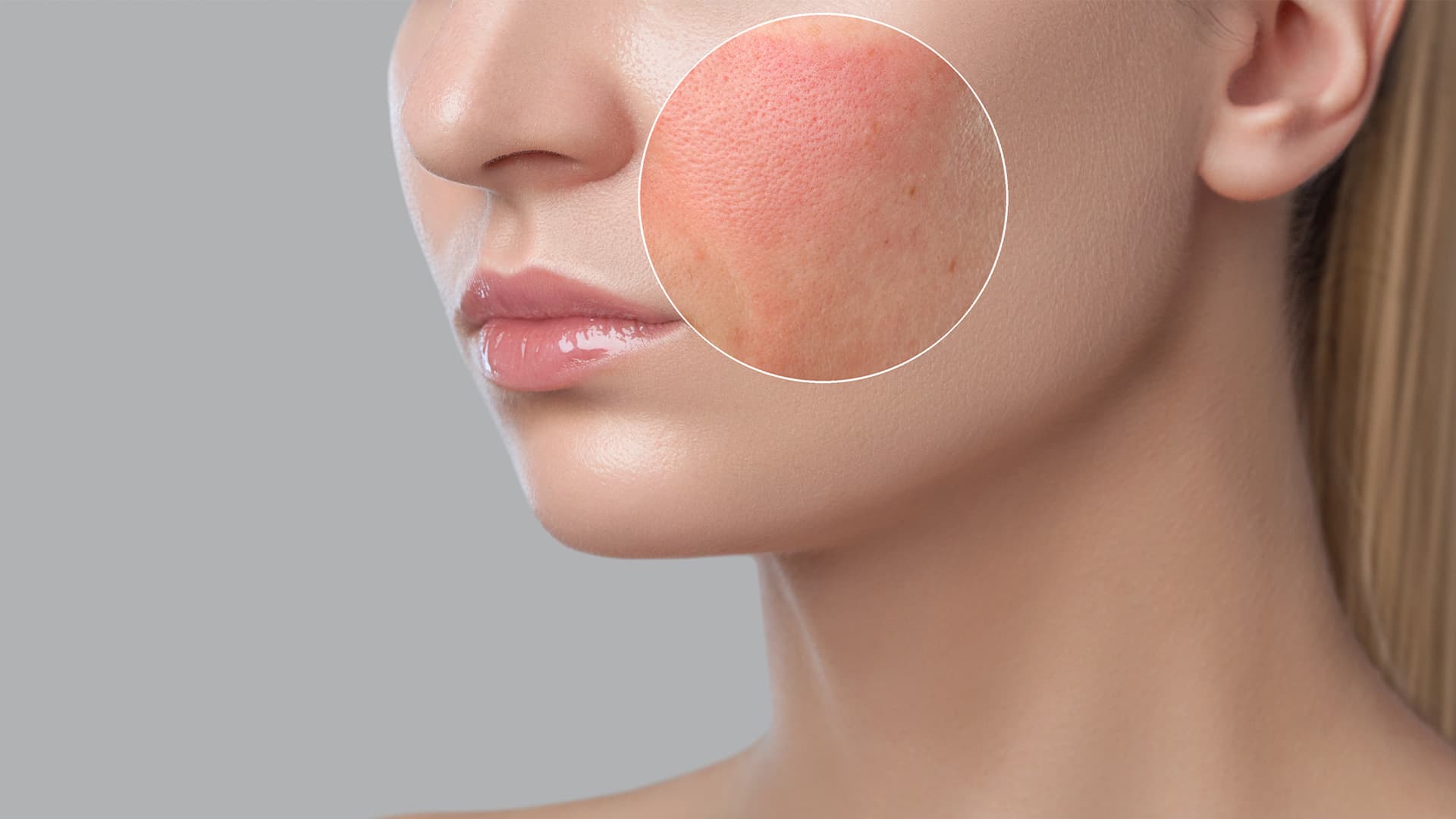 Dermatita cortizonică – consecință a utilizării inadecvate a corticosteroizilor cu aplicare topică