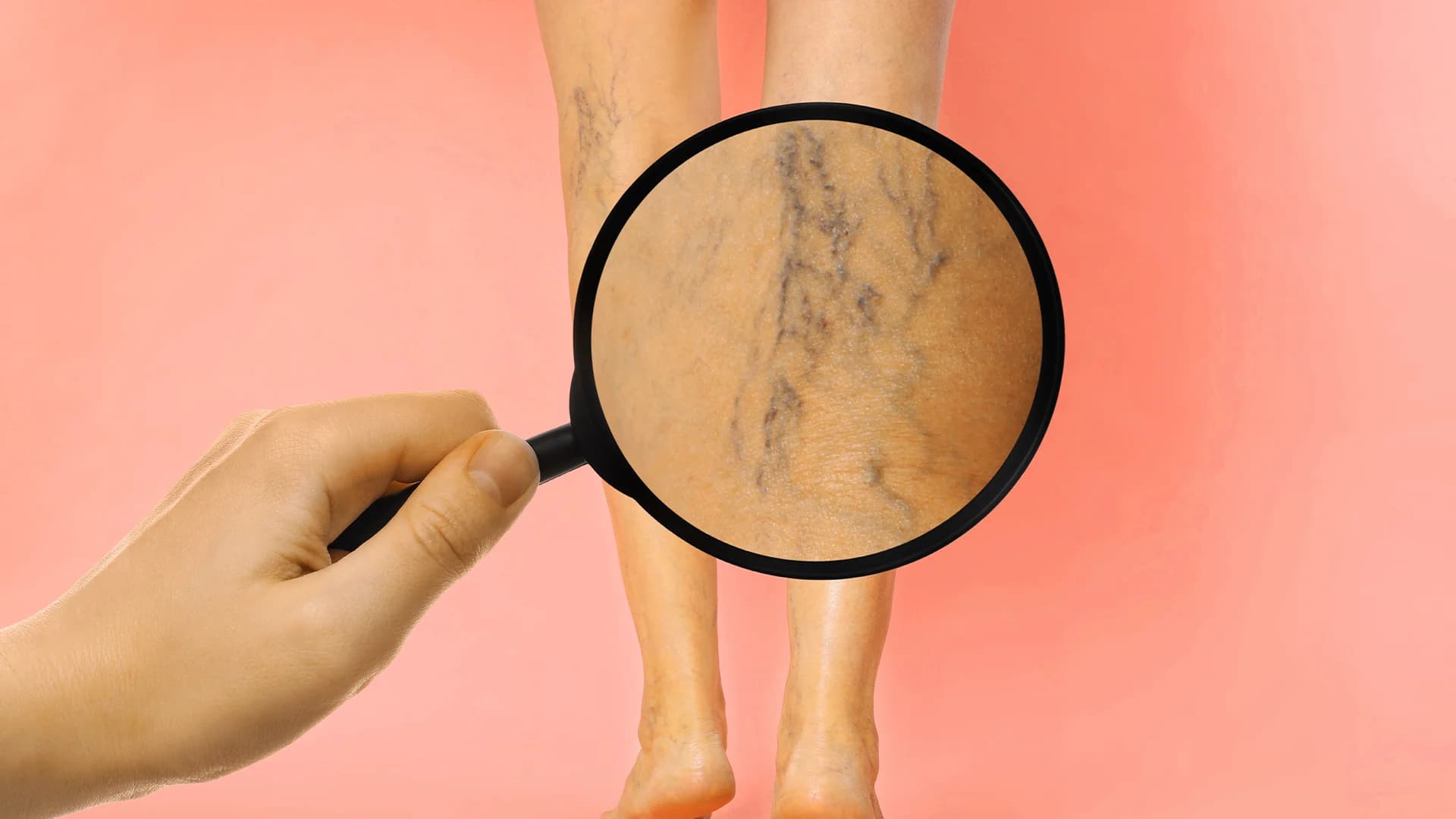 Boala venoasă cronică: management și tratament