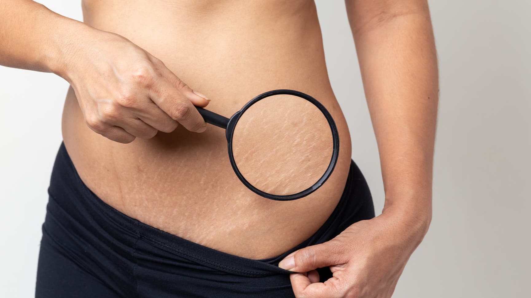 Cicatricile și vergeturile nu dispar peste noapte...dar pot fi “estompate de știință”