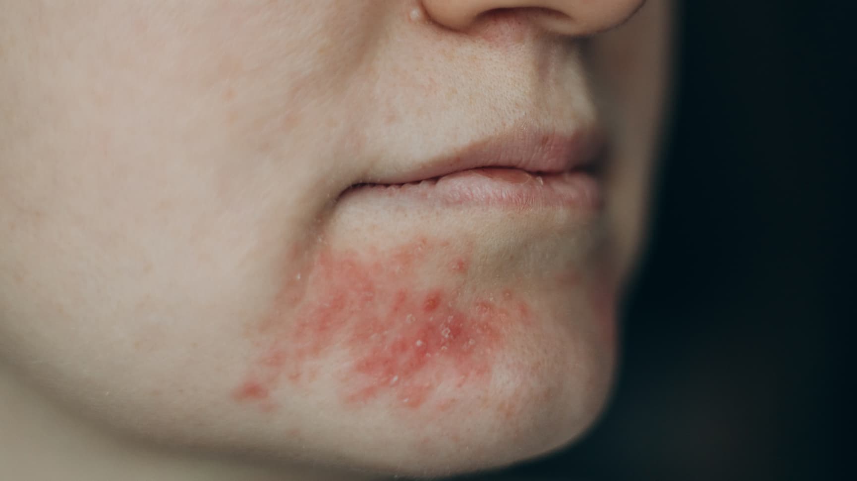 Dermatita periorală – ghid esențial pentru pacienți