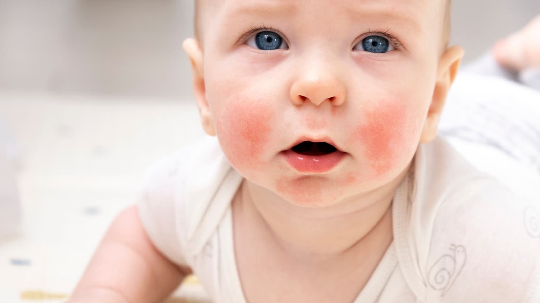 Dermatita atopicǎ la copii: între mit și realitate
